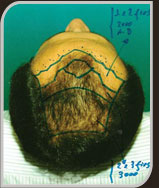 Foto do Planejamento Cirúrgico no paciente