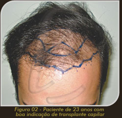 Imagem - Paciente de 23 anos com boa indicação para Transplante Capilar