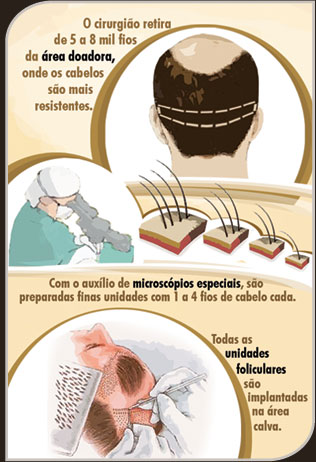 Foto do Infográfico: Transplante Capilar Foto do Infográfico: Transplante Capilar