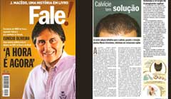 Matéria do Jornal Diário do Nordeste divulgando a técnica de Transplante de Fios Longos,trazida ao Ceará pelo Dr. Crisóstomo.