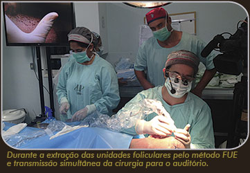 Dr. Márcio durante a extração das unidades foliculares usando o método FUE