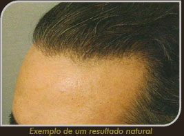 Foto do exemplo de um resultado natural - Cirurgia de Transplante Capilar