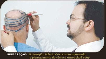 Dr. Márcio Crisóstomo marcado o planejamento da técnica Untouched Strip