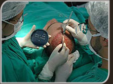 Foto da cirurgia de Implante de Cabelo